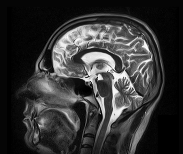 X-ray of Brain - inflammation treatment in charlotte