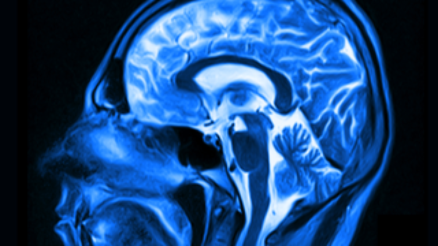 Brain X-Ray - brain inflammation treatment in charlotte
